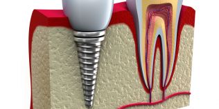 Metode revolutionare pentru un zambet frumos: implantul dentar care se monteaza in 24 de ore